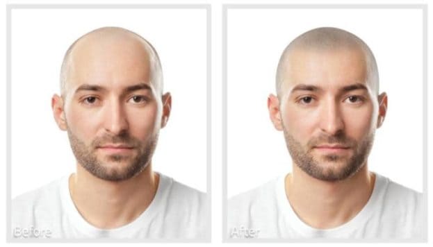 prima e dopo tricopigmentazione