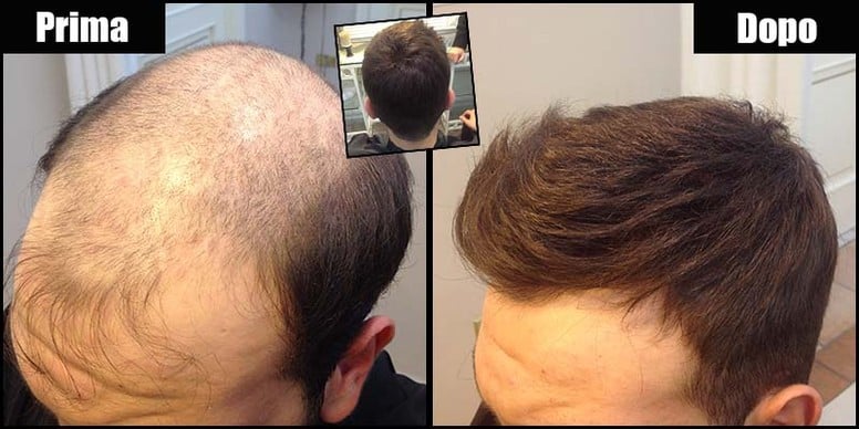 protesi capelli uomo prezzi - 63% di sconto - agriz.it