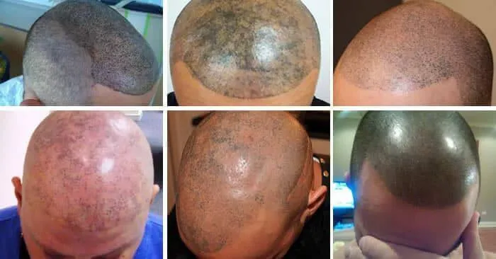 rimedi errata tricopigmentazione